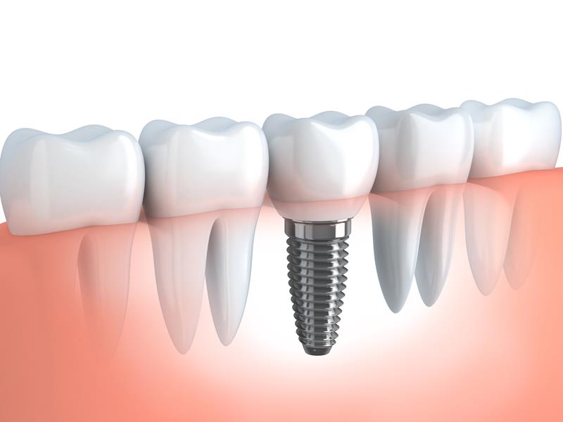 Dental Implants  Kansas City, MO 